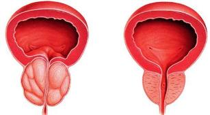 razlika bolesne i zdrave prostate