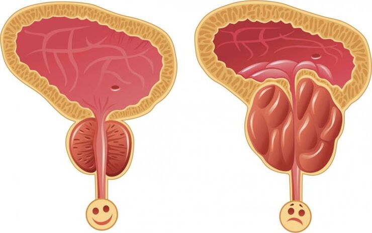 Zdrava prostata i prostatitis